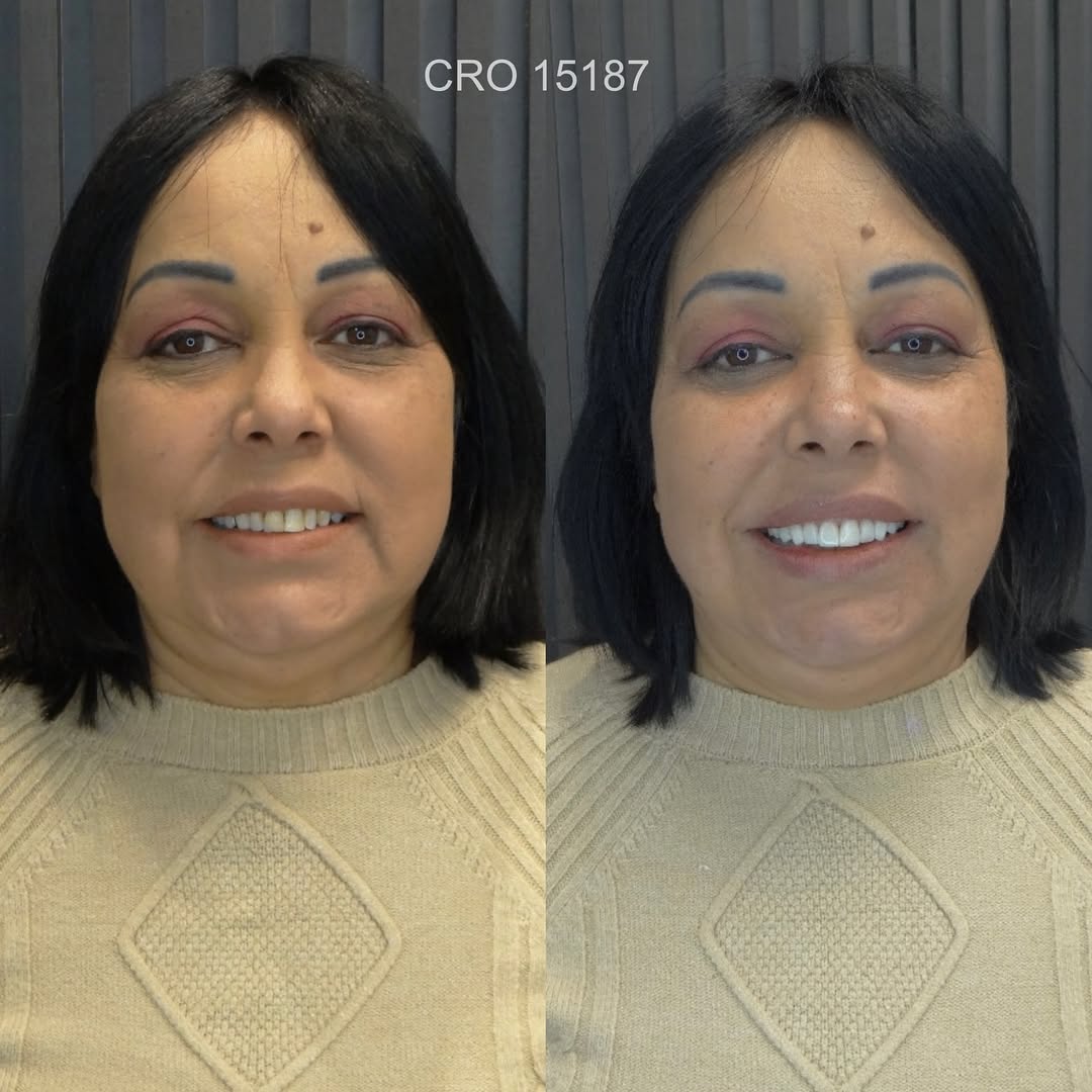 Transformação de Sorriso 9